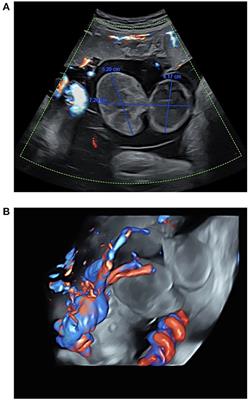 Case report: Umbilical vessel aneurysm thrombosis and factor V Leiden mutation leading to fetal demise